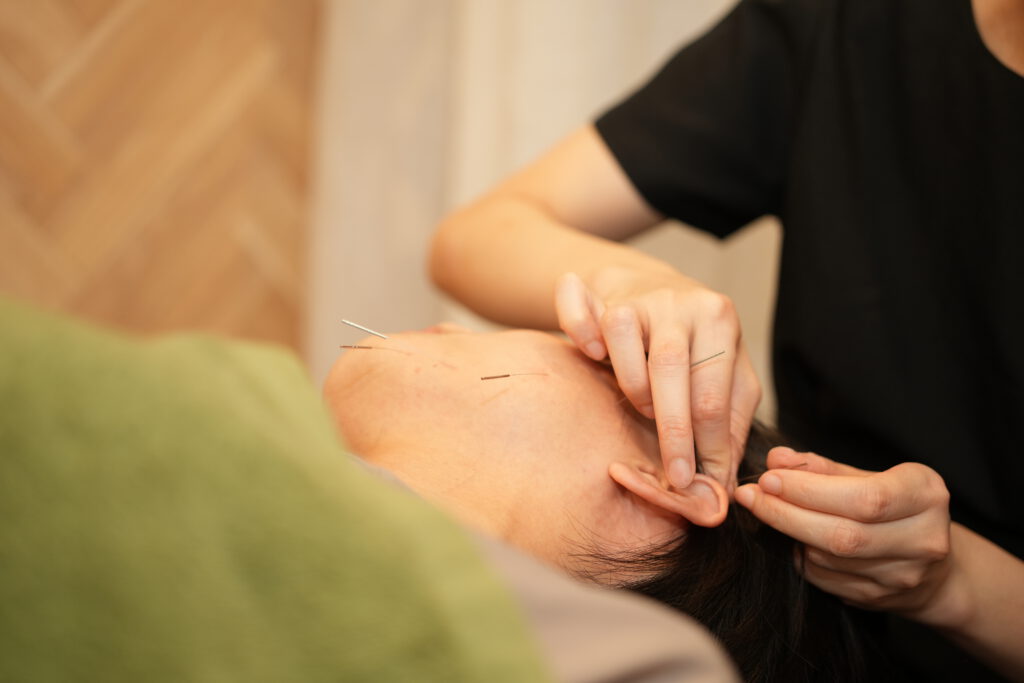 美容鍼を耳に刺している